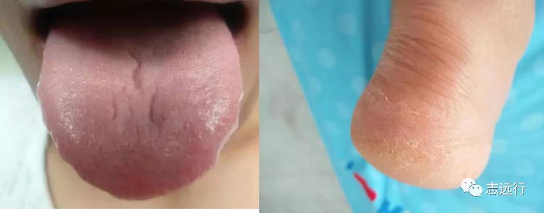 张景明治疗手足癣的中药方,手足癣单方大全