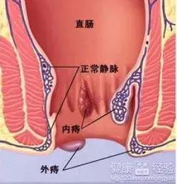 面对痔疮手术别害怕不想那么疼,痔疮为何很容易缠上准妈妈呢