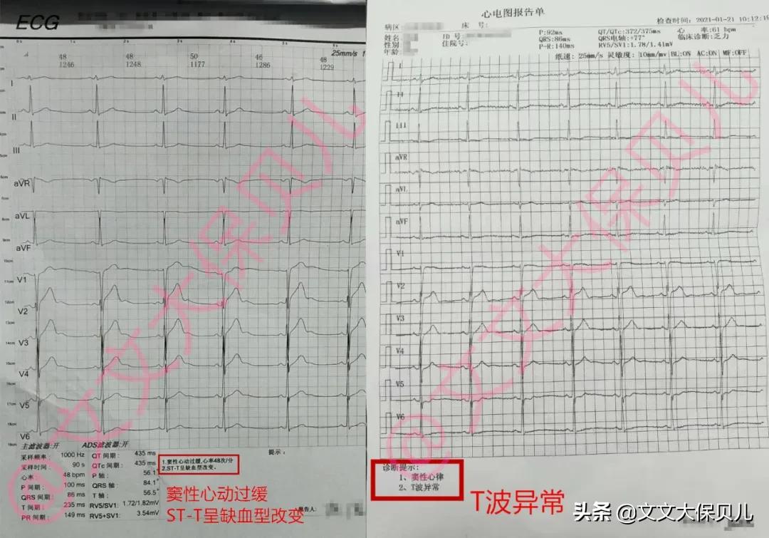 窦性心动过缓stt异常,窦性心动过缓st-t改变什么意思