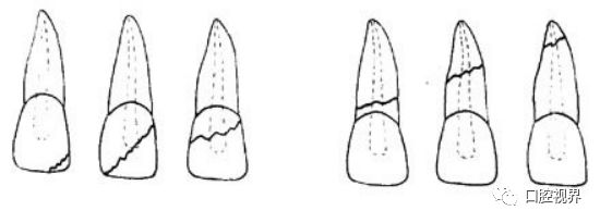 门牙受伤怎么办,门牙撞断了怎么办
