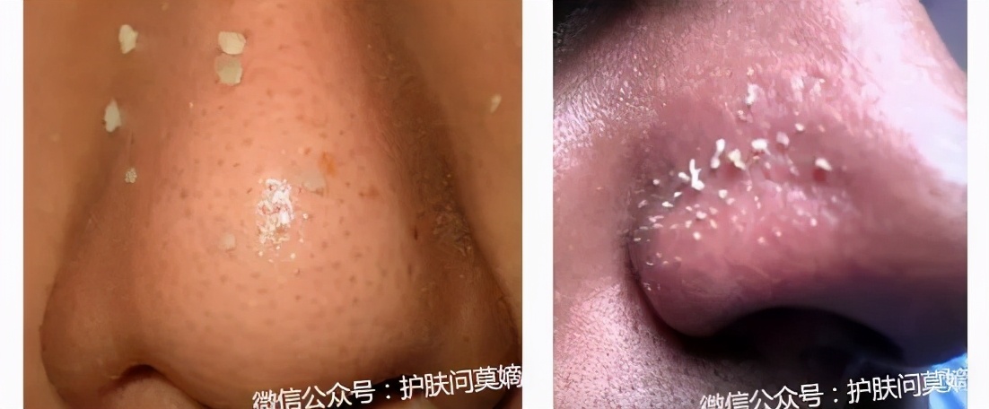 小苏打能洗脸吗去皱纹,石泽研究所的毛孔抚子