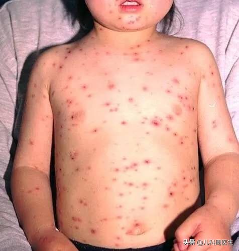 反复发热有没有可能是幼儿急疹,小孩急疹和热疹的区别
