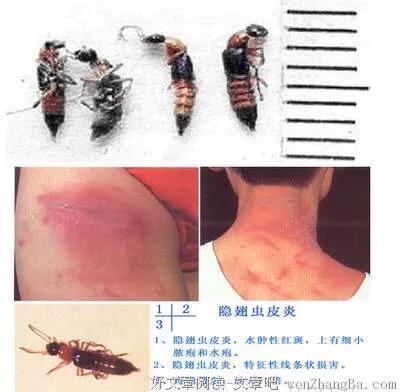 小孩被毒虫咬伤后去医院说很危险,宝宝被隐翅虫咬伤图片