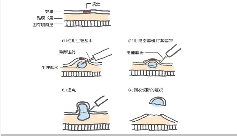 胃肠息肉会癌变么,长蒂息肉和无蒂息肉哪种容易癌变