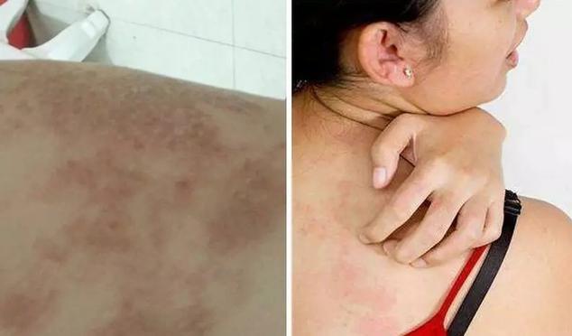 洗澡搓泥后起疙瘩,洗澡时搓出来的泥是怎么回事