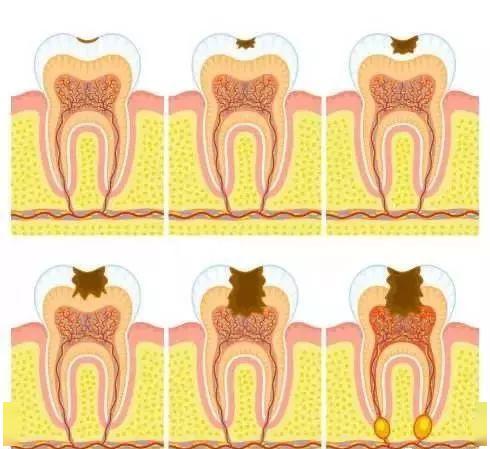 12岁牙齿有黑线怎么办自己怎么治,牙齿有黑线怎么预防不发展成龋齿
