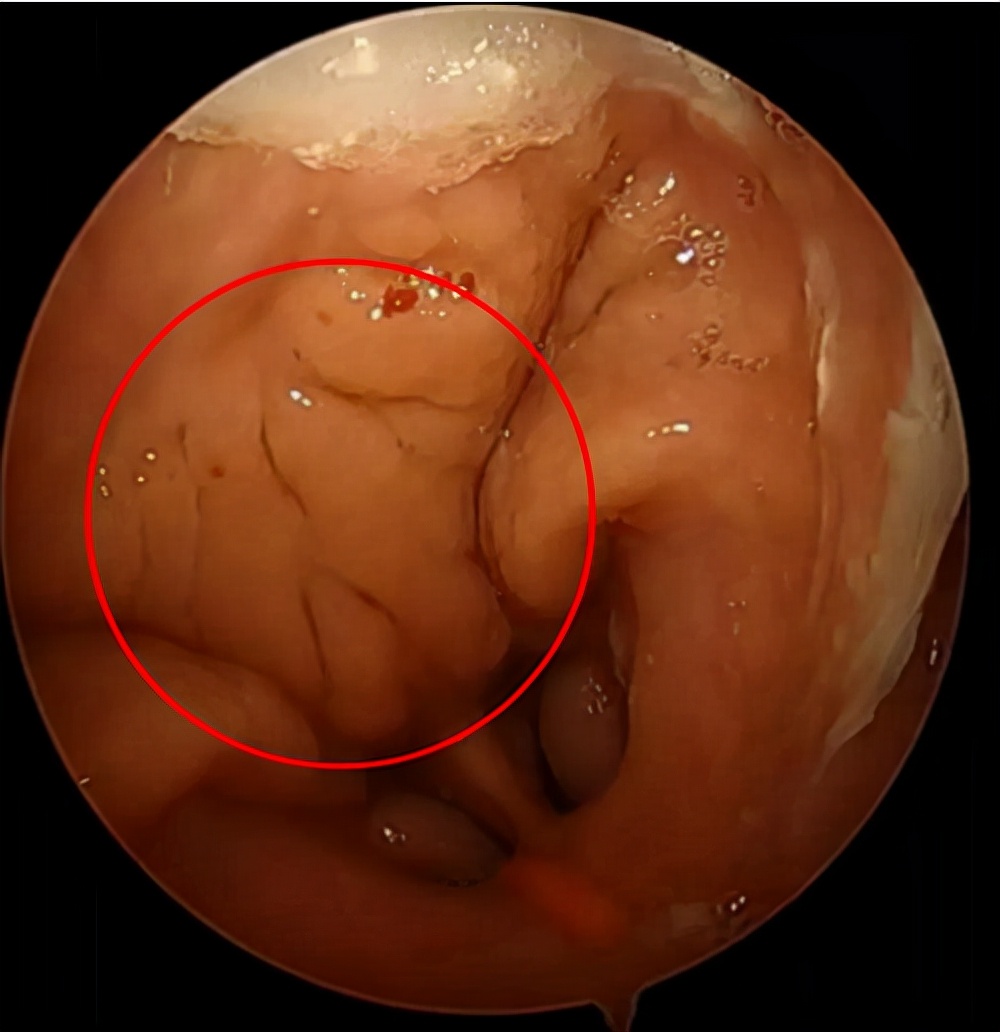 孩子打鼾别大意警惕腺样体肥大,孩子打鼾一定是腺样体肥大么