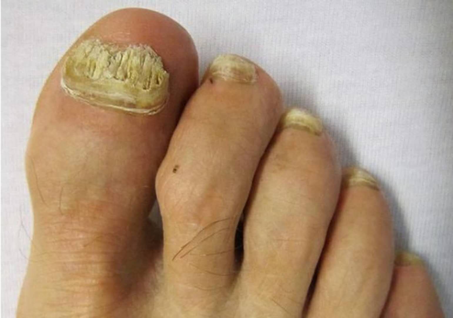 指甲变黄变空该不该剪,指甲变白变空变脆了是怎么回事