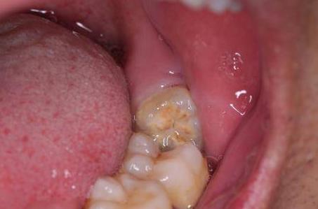 牙疼不再是问题教你如何缓解牙疼,牙疼有什么方法缓解牙疼