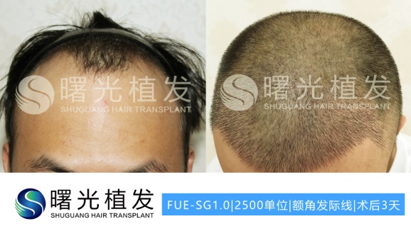 合肥脱发植发,合肥曙光植发