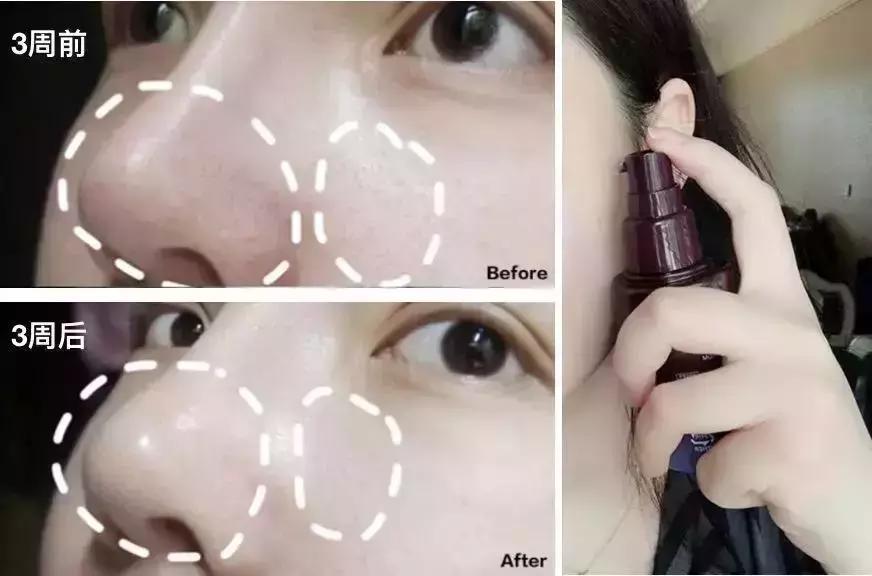 吸黑头神器去粉刺角质收缩毛孔,皮肤清洁收缩毛孔黑头角质