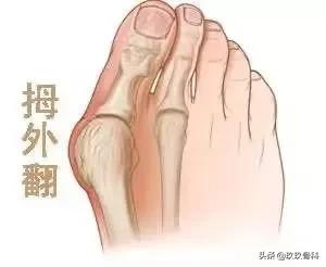 拇外翻的女人命真的苦吗,困扰女性的拇外翻