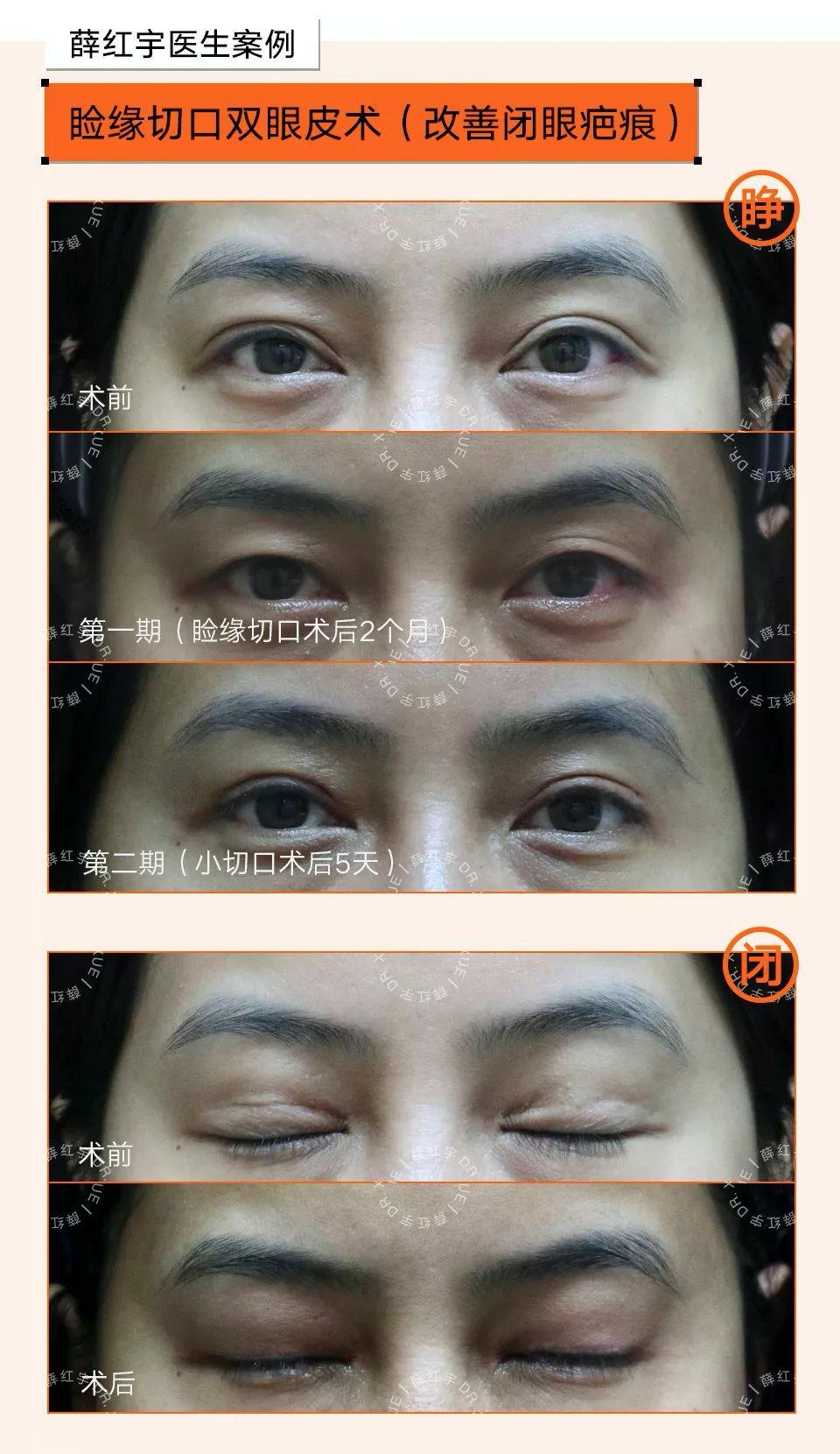 双眼皮整形修复,潘贰双眼皮修复