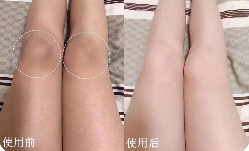 祛背部痘印的日常方法,用什么可以祛后背痘印