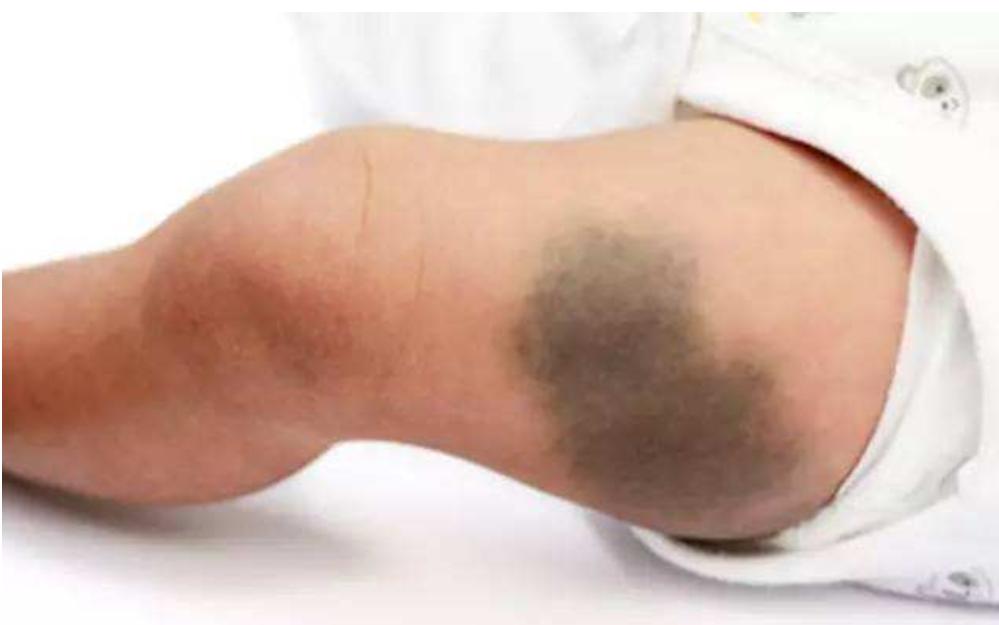 新生儿手臂上有淤青是什么原因,宝宝身上多了淤青什么引起的