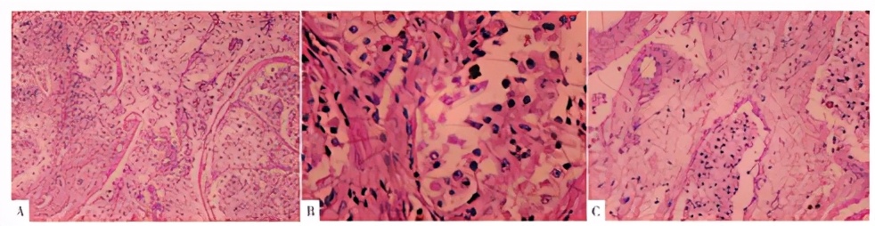子宫良恶性肿瘤的超声诊断及鉴别,子宫肌瘤病理切片恶性肿瘤