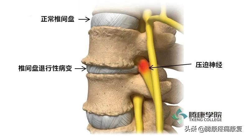 腰椎间盘退行性改变怎么治疗呢,腰椎间盘退行性改变是什么意思