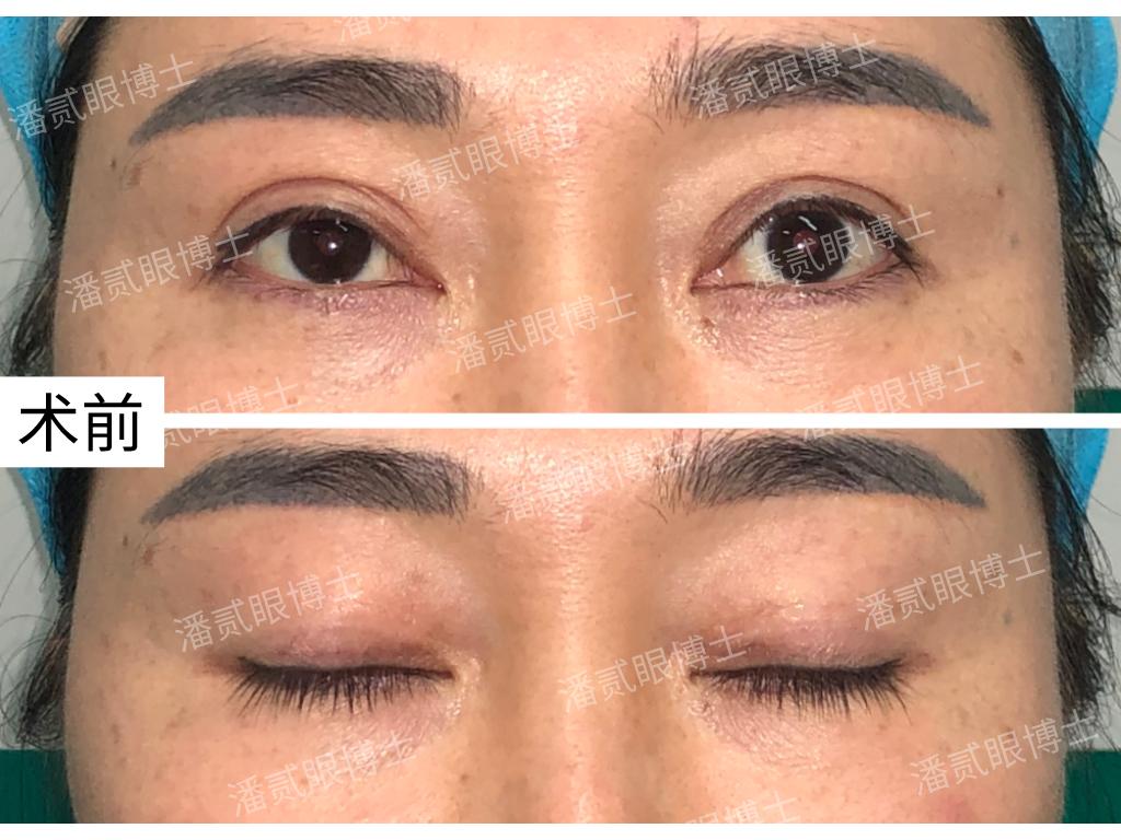 东莞做无痕双眼皮,东莞双眼皮修复