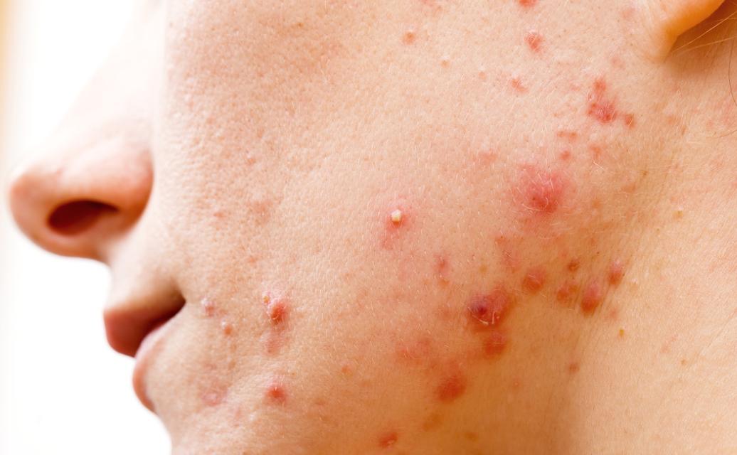 为什么身上会长“肉疙瘩”?是脂肪瘤吗?医生教你如何判断