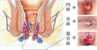 痔疮手术pph微创术多少钱,最安全的痔疮手术是哪种