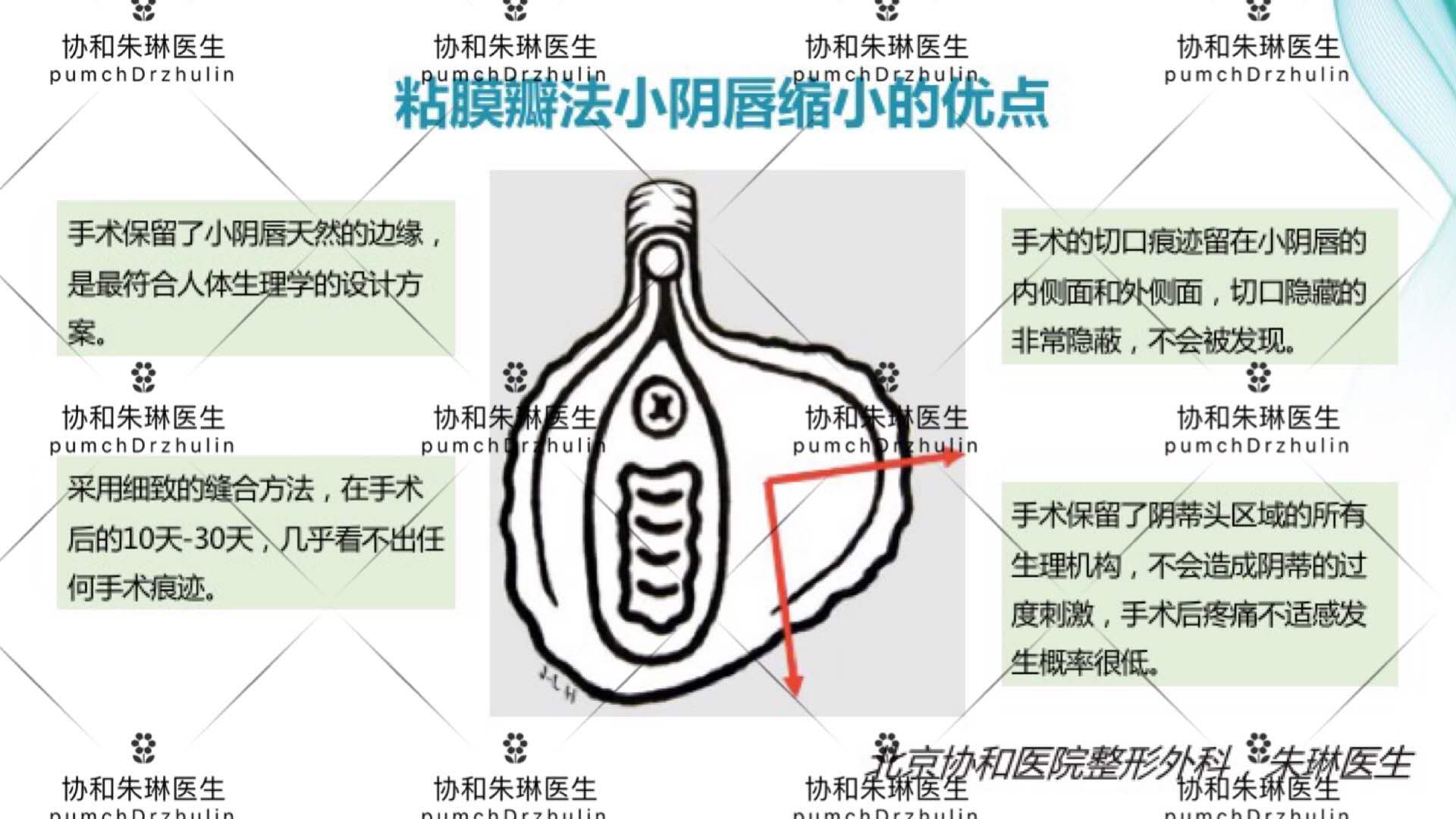 简单粗暴的小阴唇“一刀切”，为什么坚决不能做？