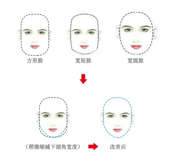颧骨下颌角手术十天,颧骨宽可以做什么手术