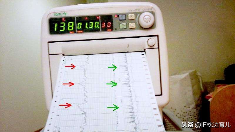 胎心监护曲线波动比较大,胎心监护上什么代表有宫缩