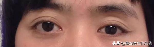 近视凸眼能做双眼皮吗,眼睛凸可以做手术改变吗