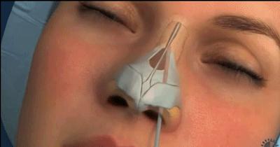 不做手术提高鼻梁的方法,不做手术鼻梁增高方法