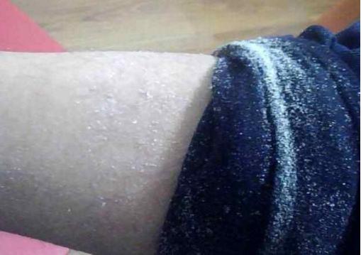 身体干燥起皮用哪种凡士林身体乳,冬天皮肤干可以涂甘油加面霜吗