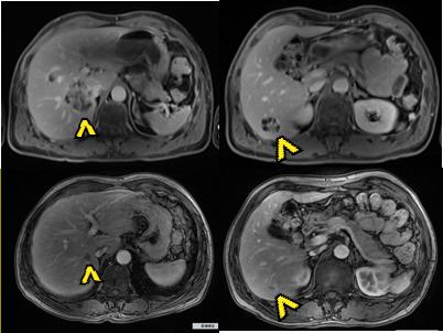 精准放疗高效解决鼻咽癌免疫治疗后寡进展病例分享