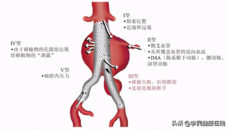 血管外科介入新技术,21世纪血管外科发展方向微创治疗
