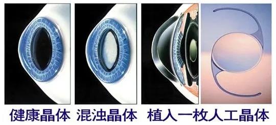 高岩院长做客健康时间——手术治疗白内障的最佳时期是什么时候?