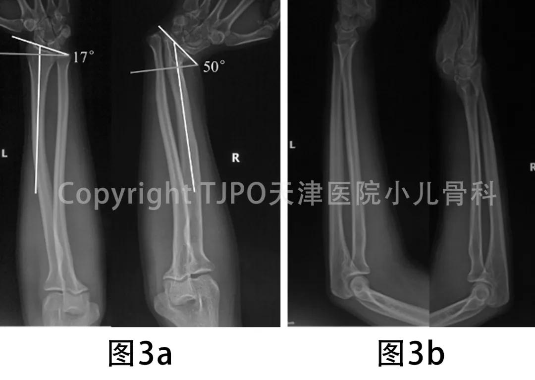 桡骨小头畸形截骨矫形,小儿尺桡骨远端发育迟缓畸形