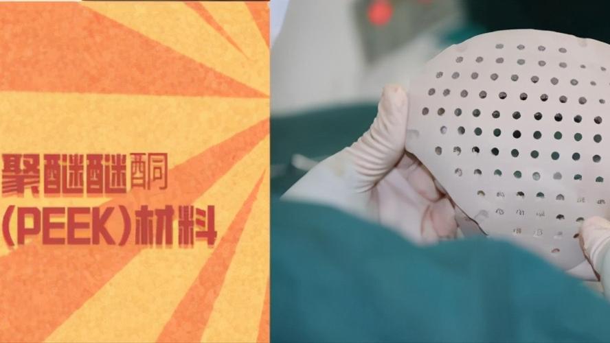 颅骨缺损修补的护理目标,颅骨缺损修补后还算缺损吗