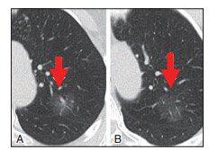 肺结节中的ggo代表什么,肺结节ggn与ggo有什么区别