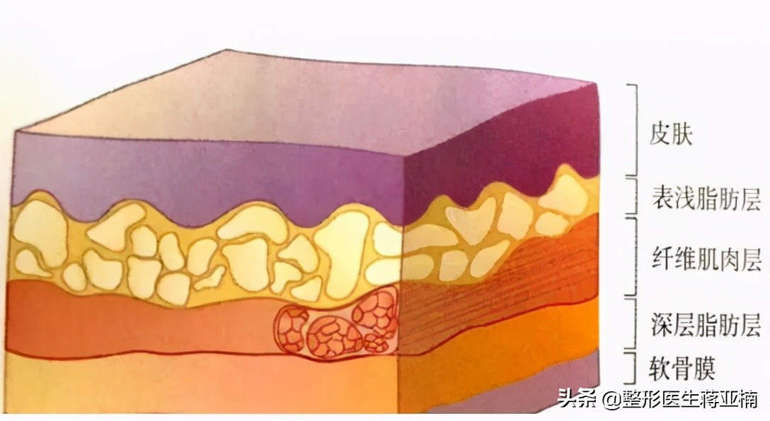 什么鼻整形需要经常修复,如何快速恢复隆鼻手术