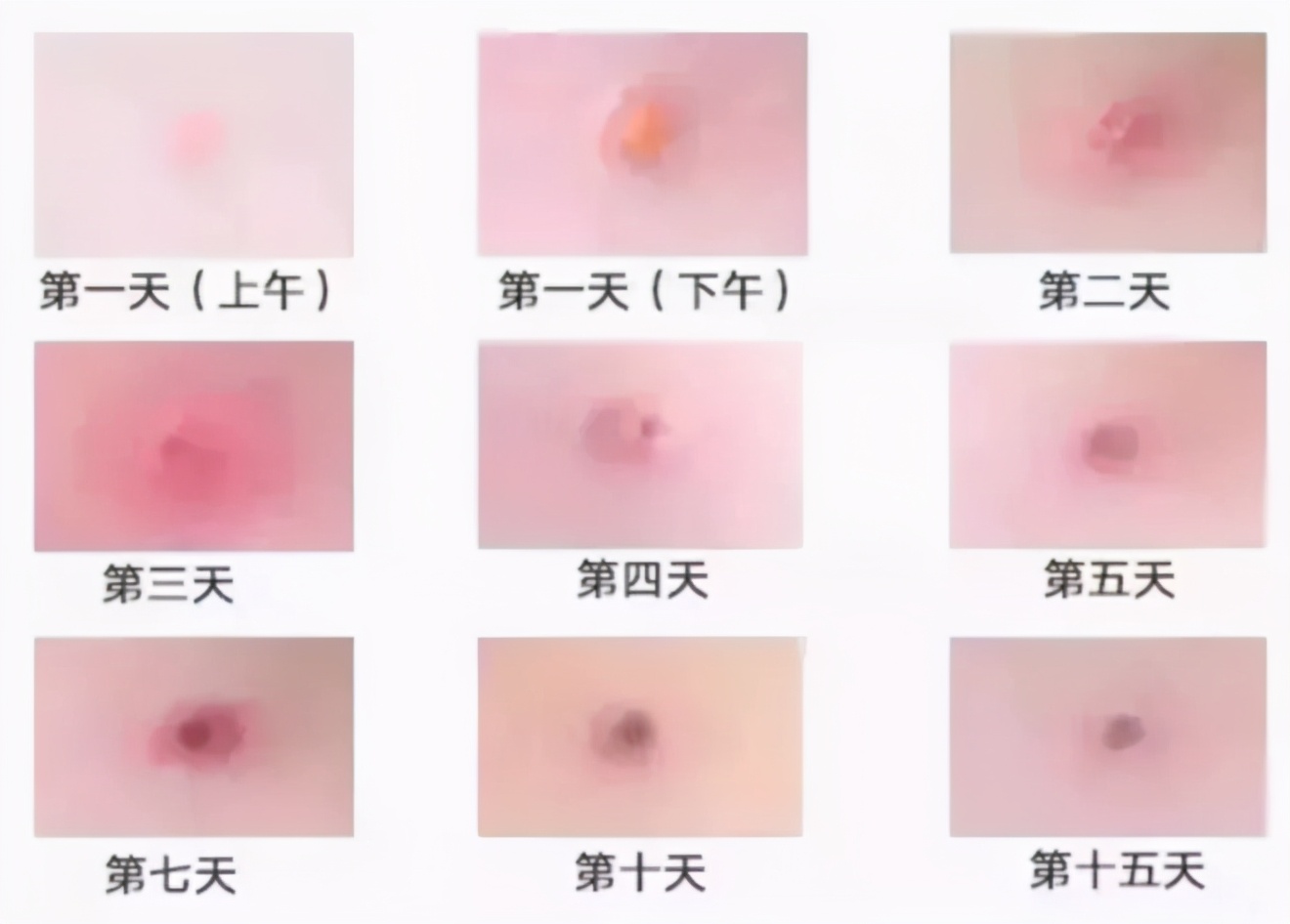 长水痘要隔离多久才不会传染,水痘需要隔离多长时间才能上学