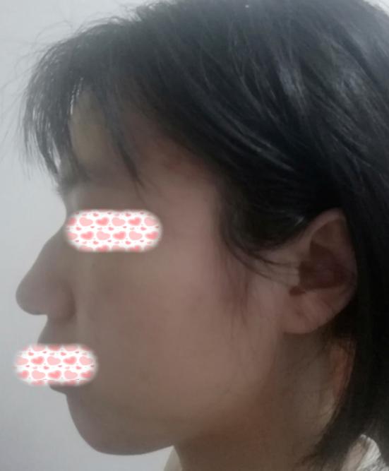 面部微调脸型,如何改善脸型整形