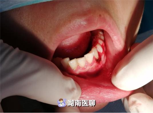 原创科普牙龈有问题孕期莫忽视,孕期牙龈上长了个小肉疙瘩图片