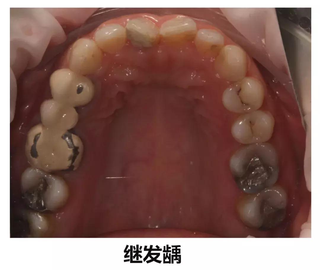 牙齿正面有小黑点千万不要忽视,不要小看牙齿的小黑点