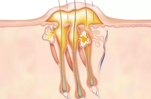 挤痘痘之后的正确处理方式,挤痘痘后正确处理方法
