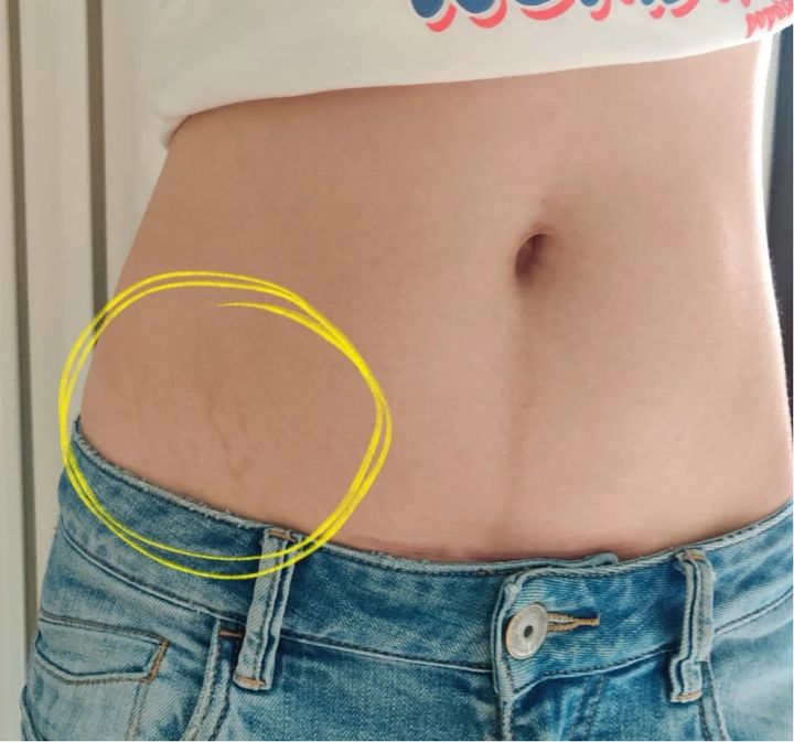 不想长妊娠纹该怎么增加体重,不想长皱纹要怎么做