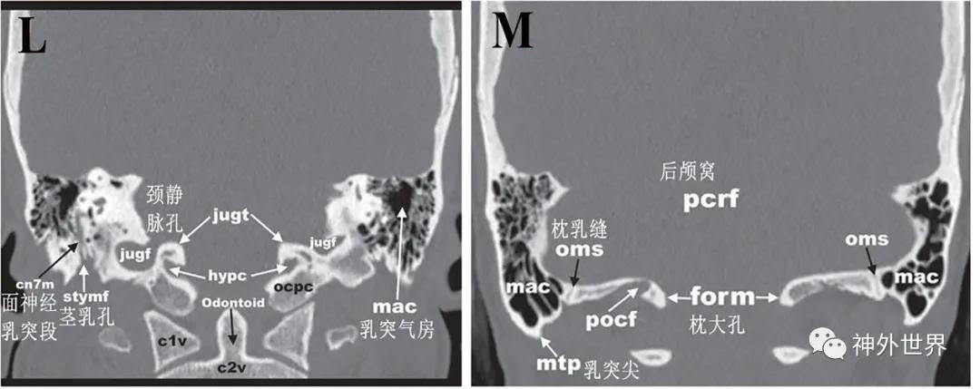 颅底骨折合并脑脊液漏伤情鉴定,颅底骨折伴脑脊液漏右眼眶骨折