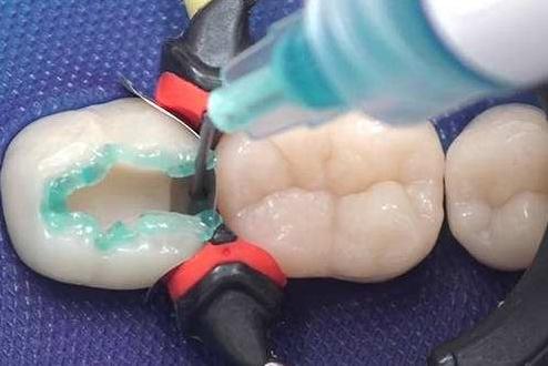 为什么补牙后牙疼脖子也是疼的,为啥补牙后开始痛