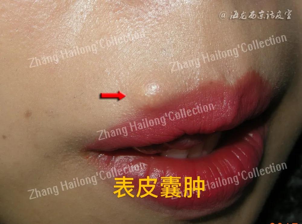 表皮囊肿会引起癌变吗,表皮囊肿是先天性的吗