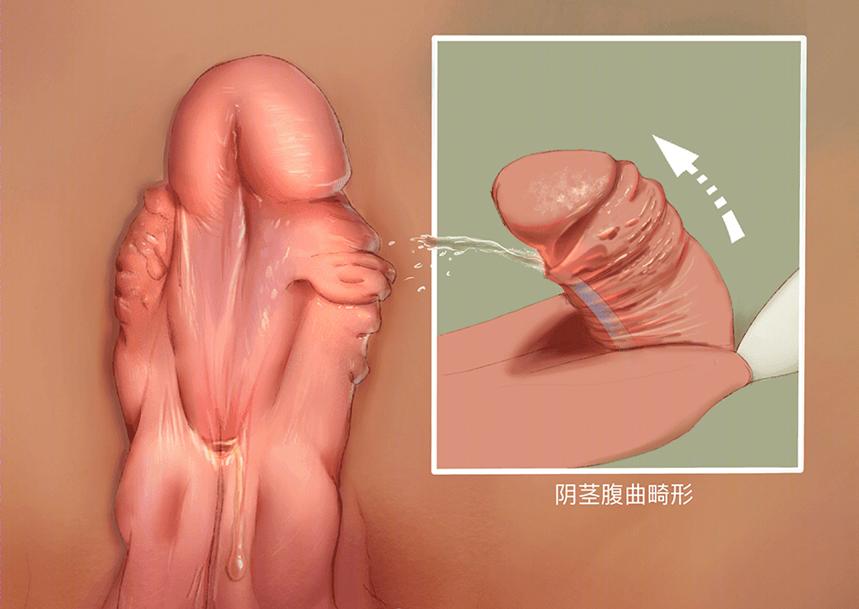男婴儿尿道下裂原因,男宝宝尿道下弯处理