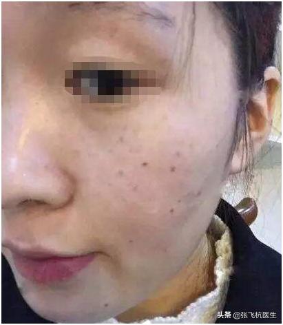 长斑最好的三种食物,去褐斑的食物