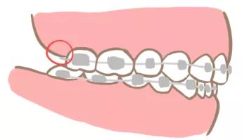 正畸疫情复诊,口腔科应对新冠疫情的控制措施