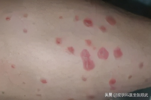 春节期间牛皮癣怎么治疗,牛皮癣冬季复发原因与调理